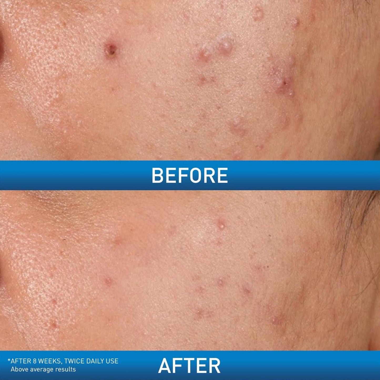 CeraVe Acne Control Gel