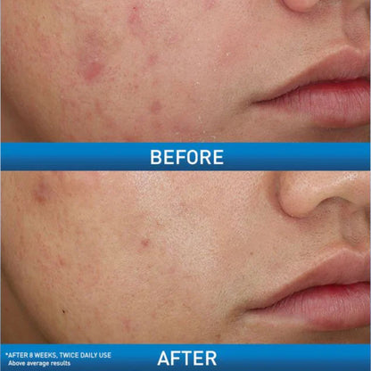 CeraVe Acne Control Cleanser